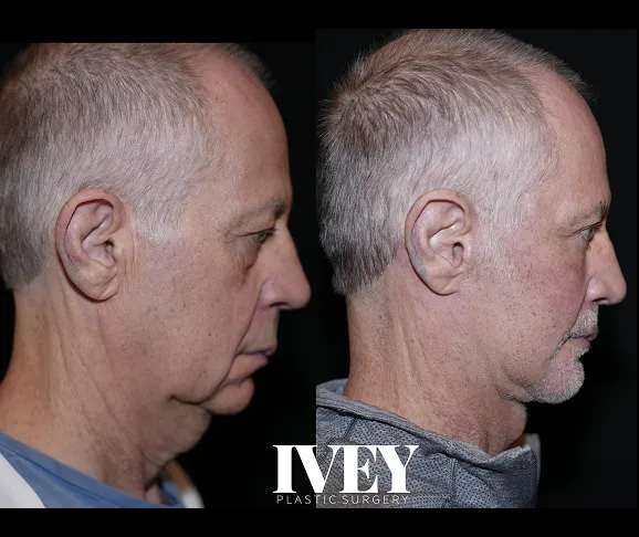 Side-by-side profile photos of an older man showing a tighter neck and jawline after plastic surgery.