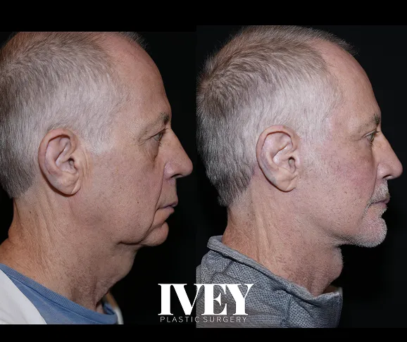 Side-by-side profile photos of older man before and after plastic surgery showing neck and jawline improvements.