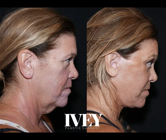 Side-by-side before and after photos of a woman showing facial skin tightening results.