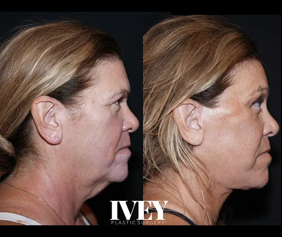 Side-by-side profile of a woman's face before and after plastic surgery showing tightened skin and jawline.