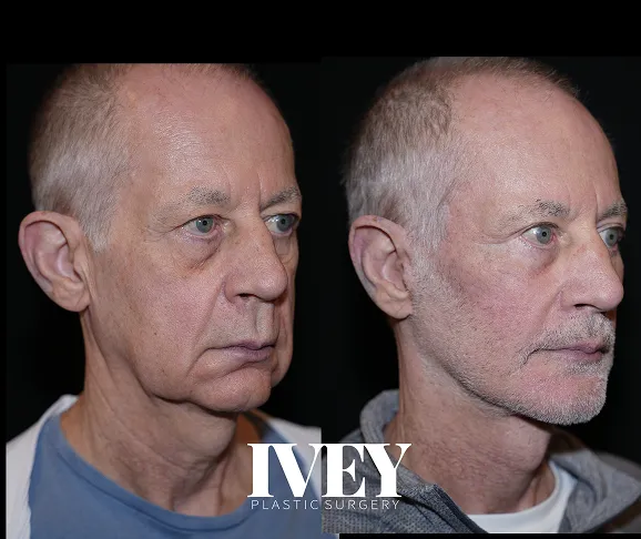Side-by-side before and after photos of an older man showing facial improvements after plastic surgery.
