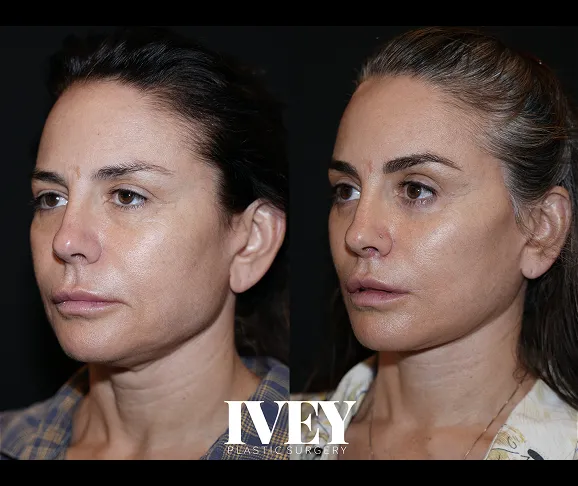 Side-by-side before and after photos of a woman's face showing softer jawline and fuller lips post-surgery.