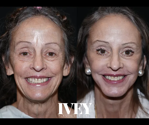 Side-by-side facial before and after images of an older woman showing skin and cosmetic improvements.