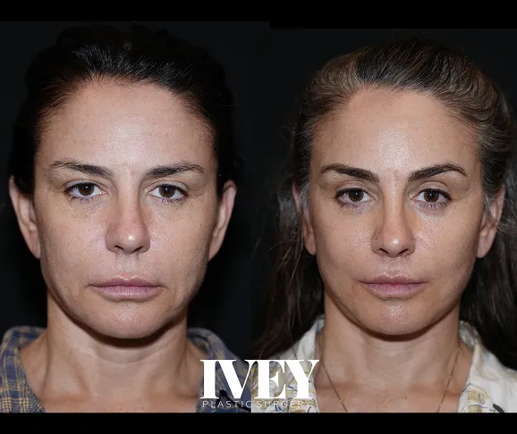 Before and after images of a woman's face showing subtle improvements in skin tone and texture.