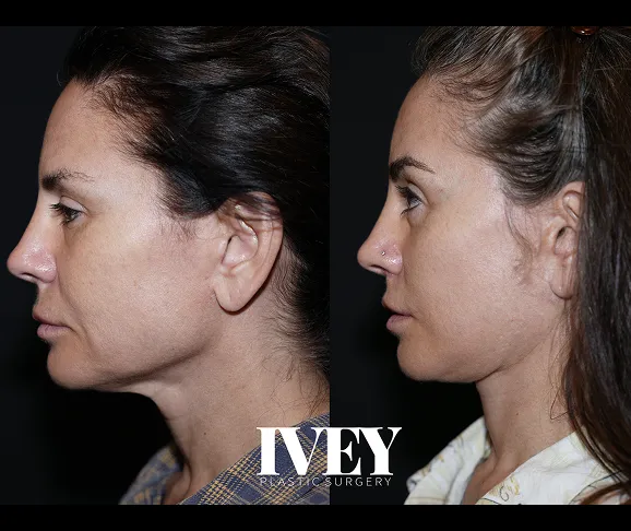 Before and after side profiles of a woman showing subtle facial contour changes after plastic surgery.