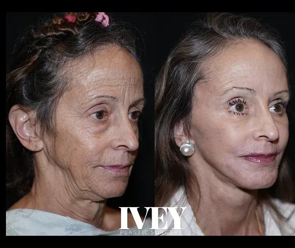 Side-by-side before and after photos of an older woman showing smoother skin after cosmetic treatment.