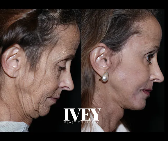 Side-by-side profile of an older woman before and after facelift showing smoother, tighter skin.