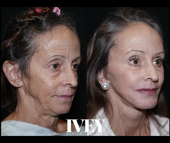 Side-by-side photos show a woman before and after plastic surgery with smoother skin and fuller lips.