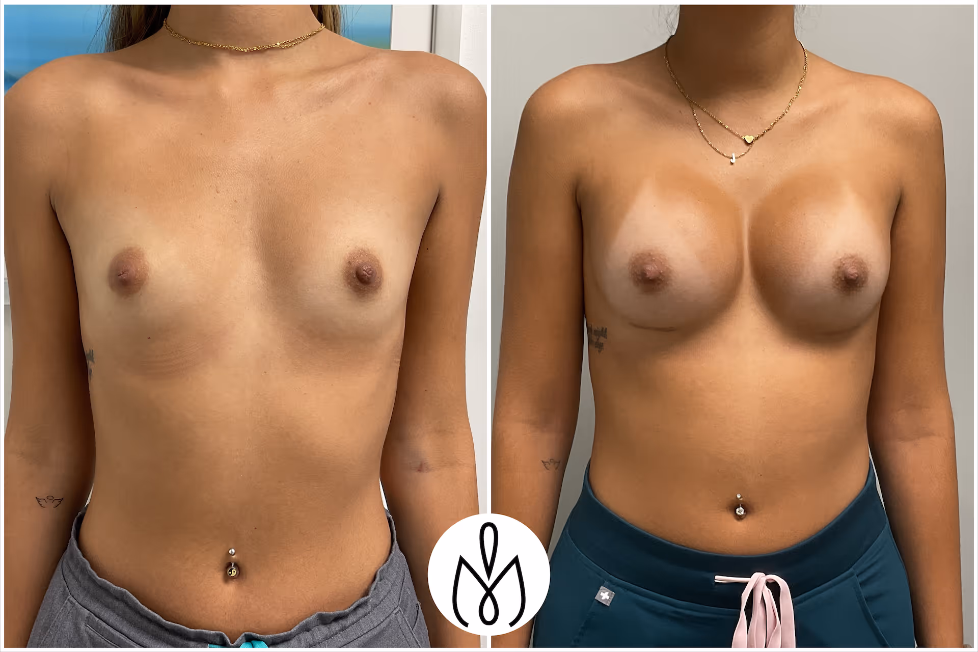 Before,After
