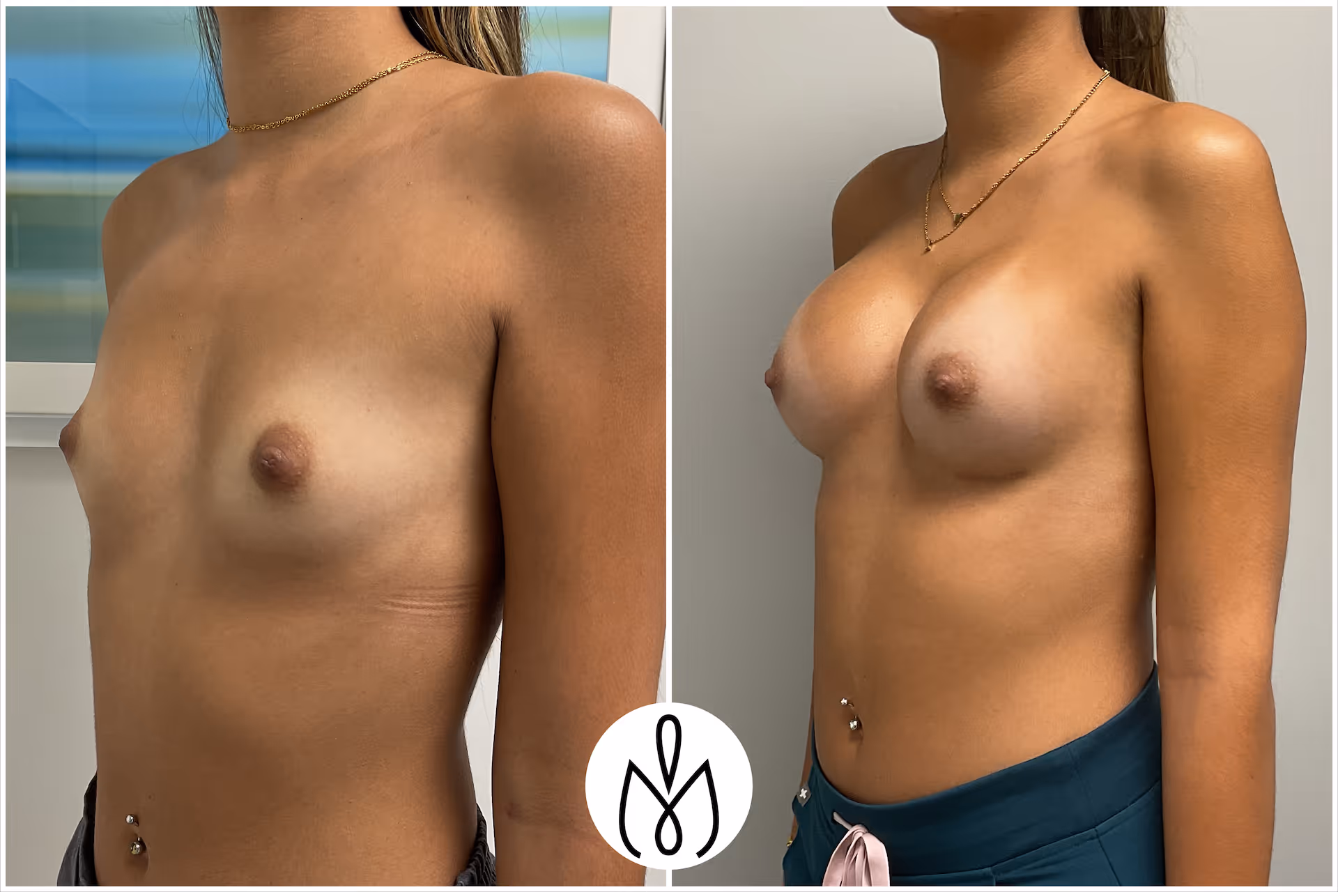 Before,After