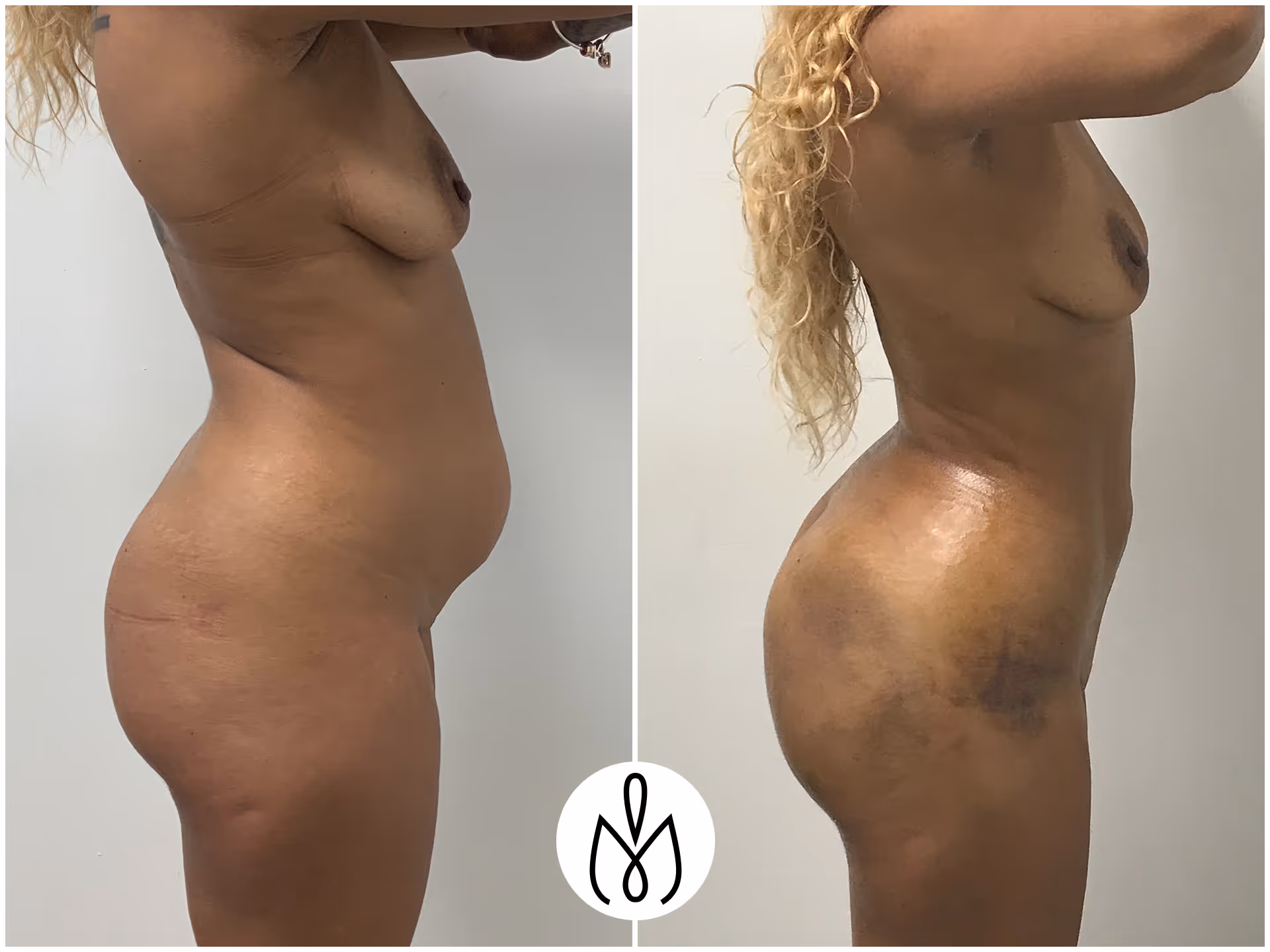 Before,After