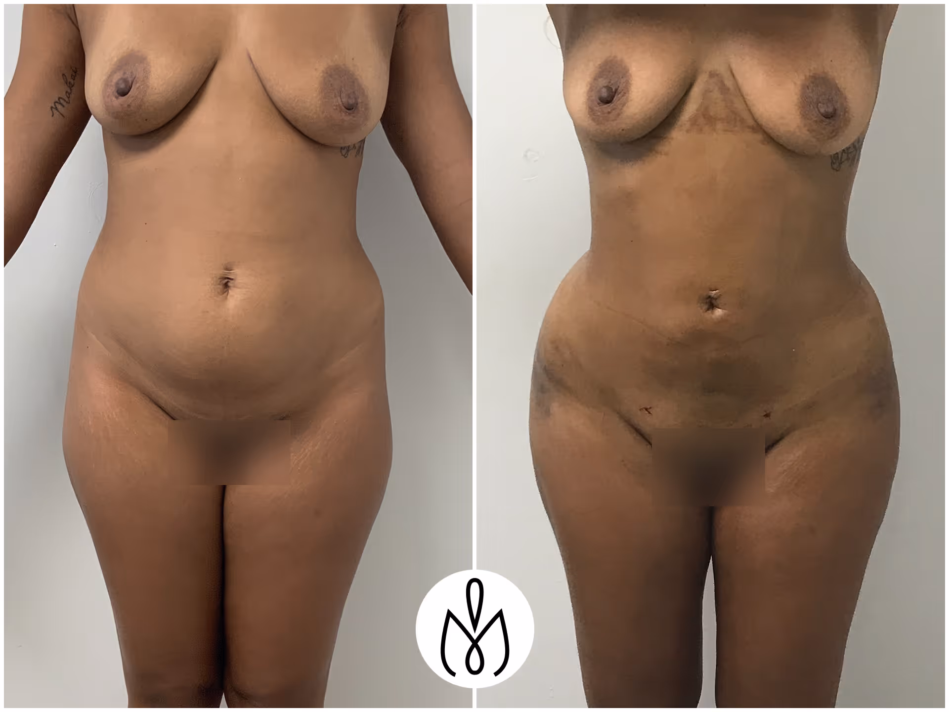 Before,After