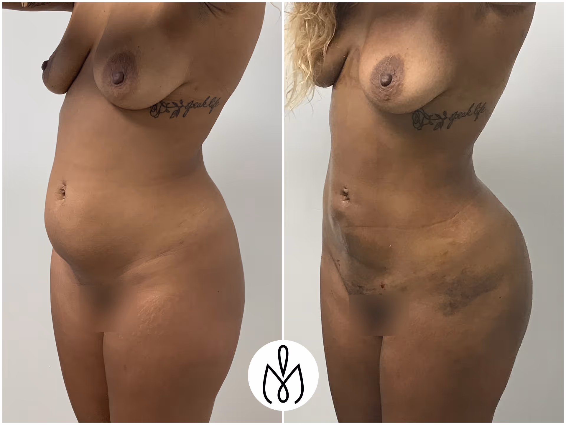 Before,After