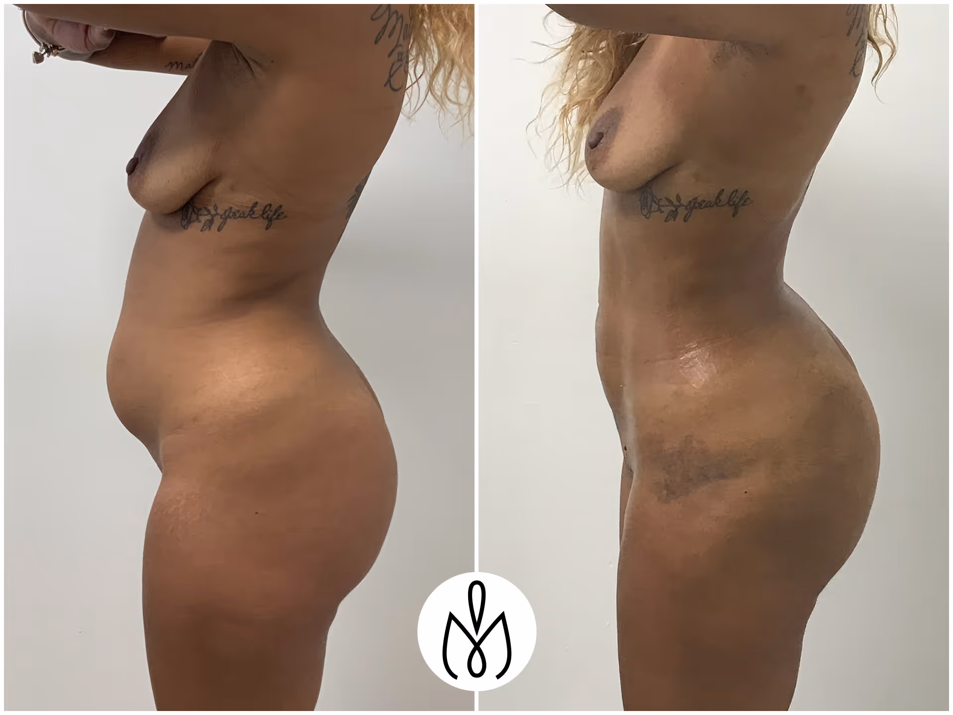 Before,After