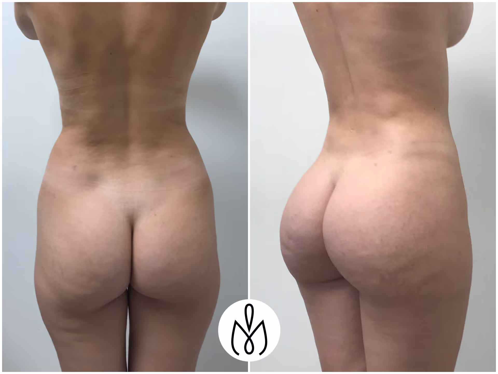 Before,After