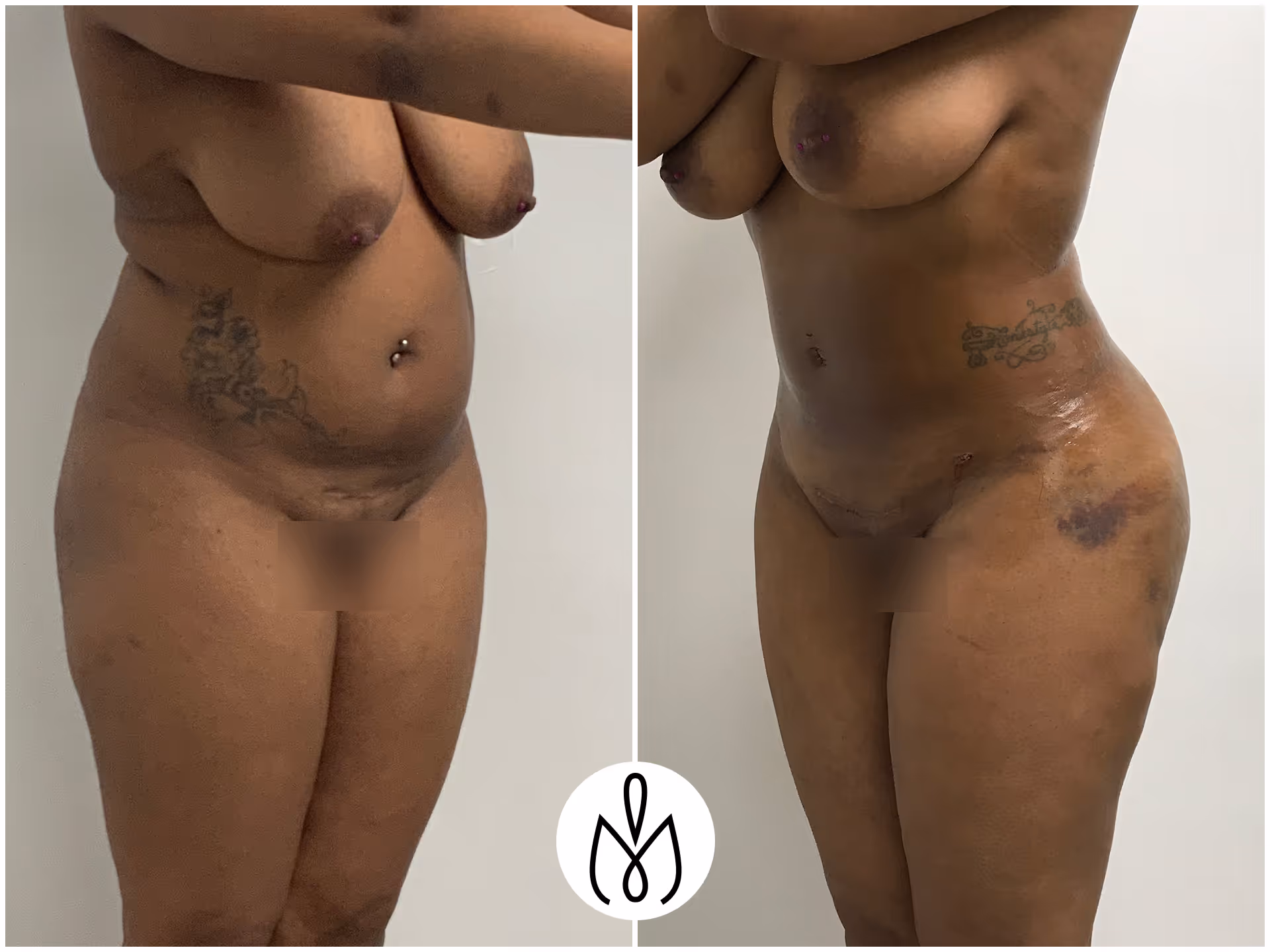 Before,After