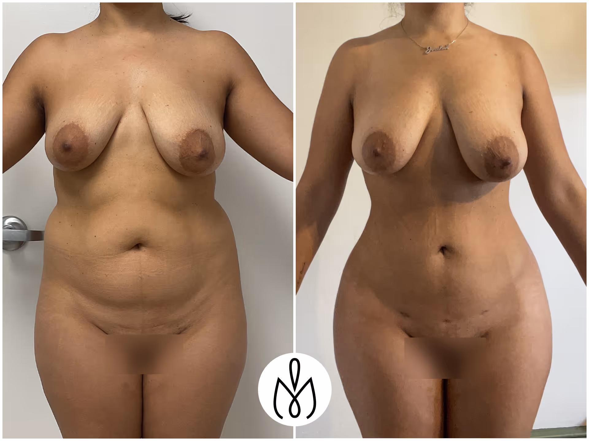 Before,After