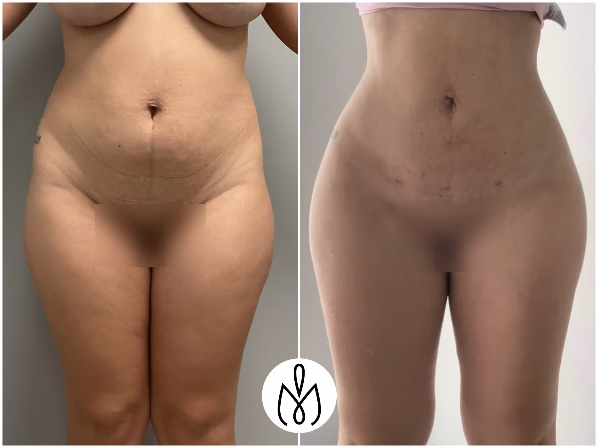 Before,After