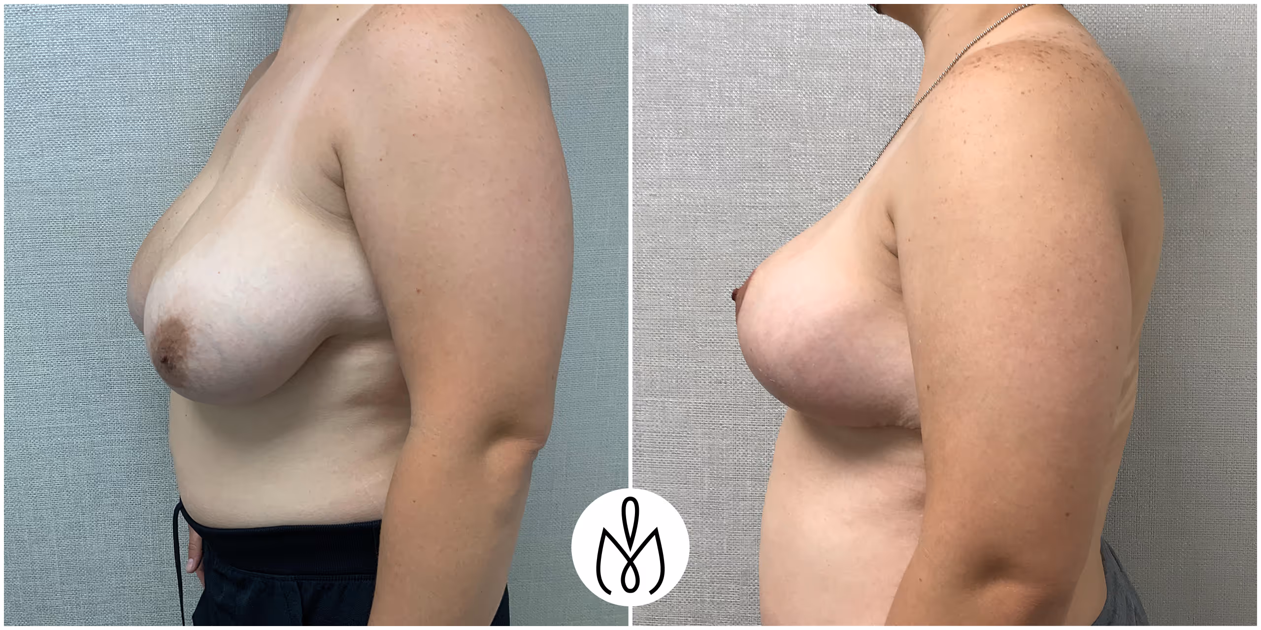 Before,After