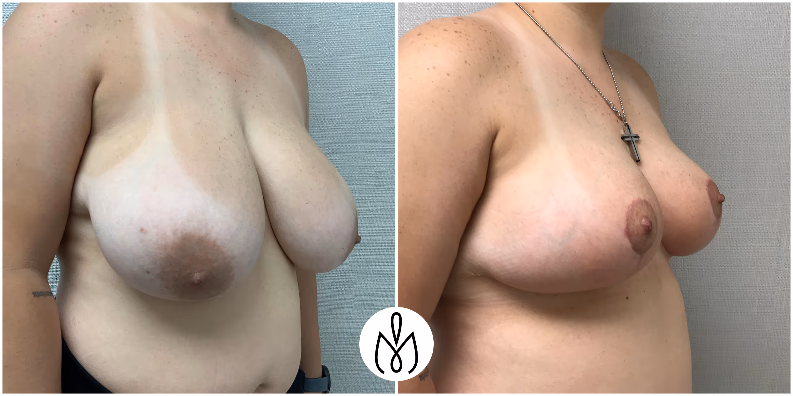 Before,After