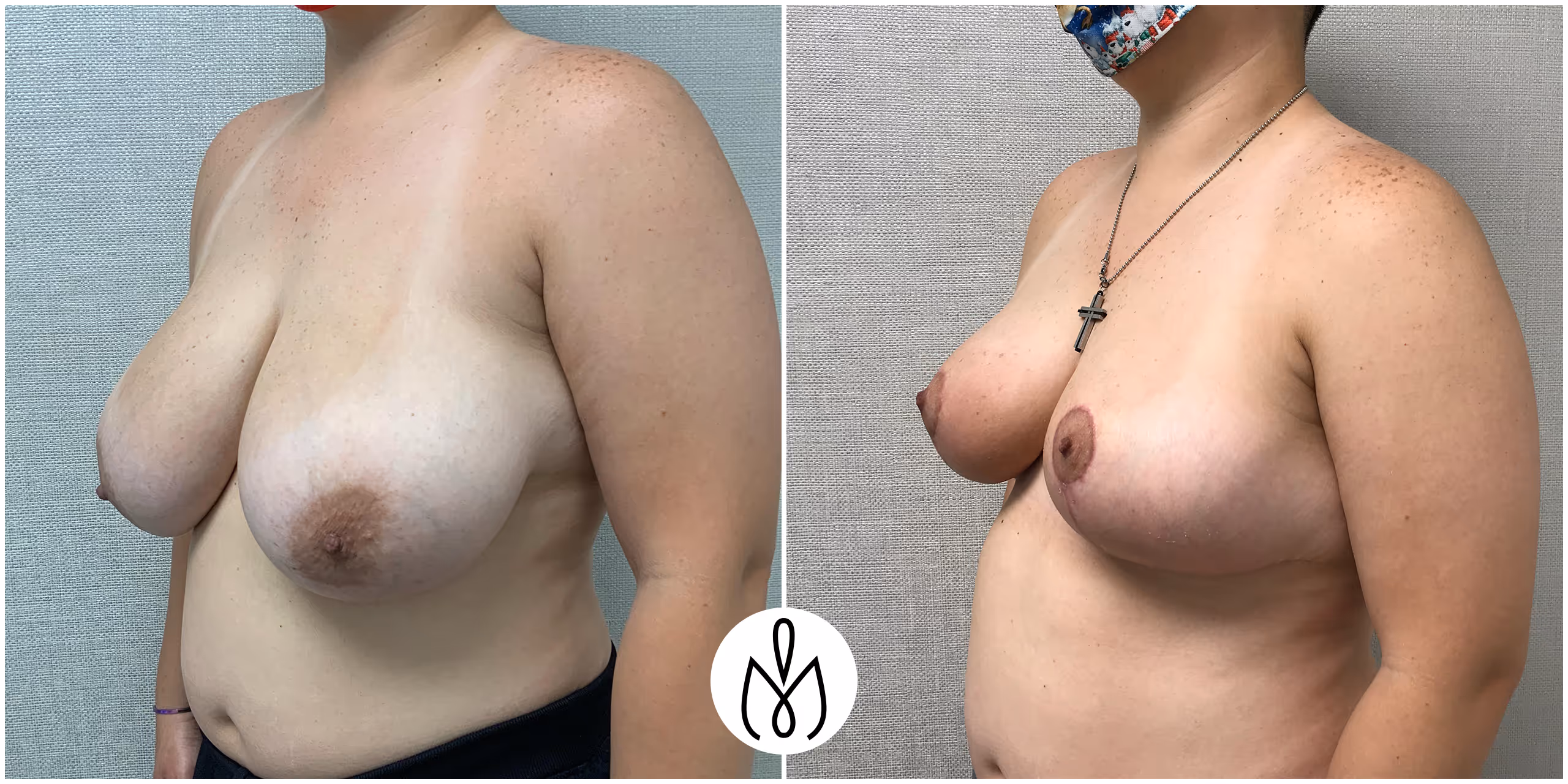 Before,After