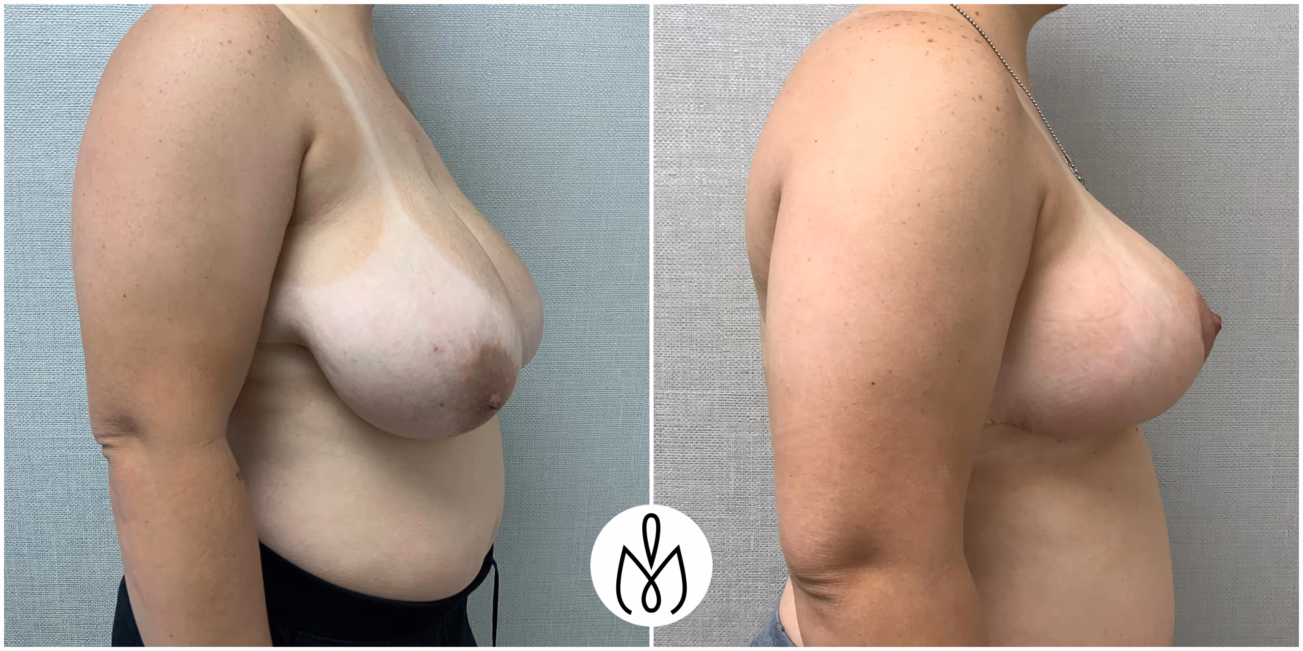 Before,After