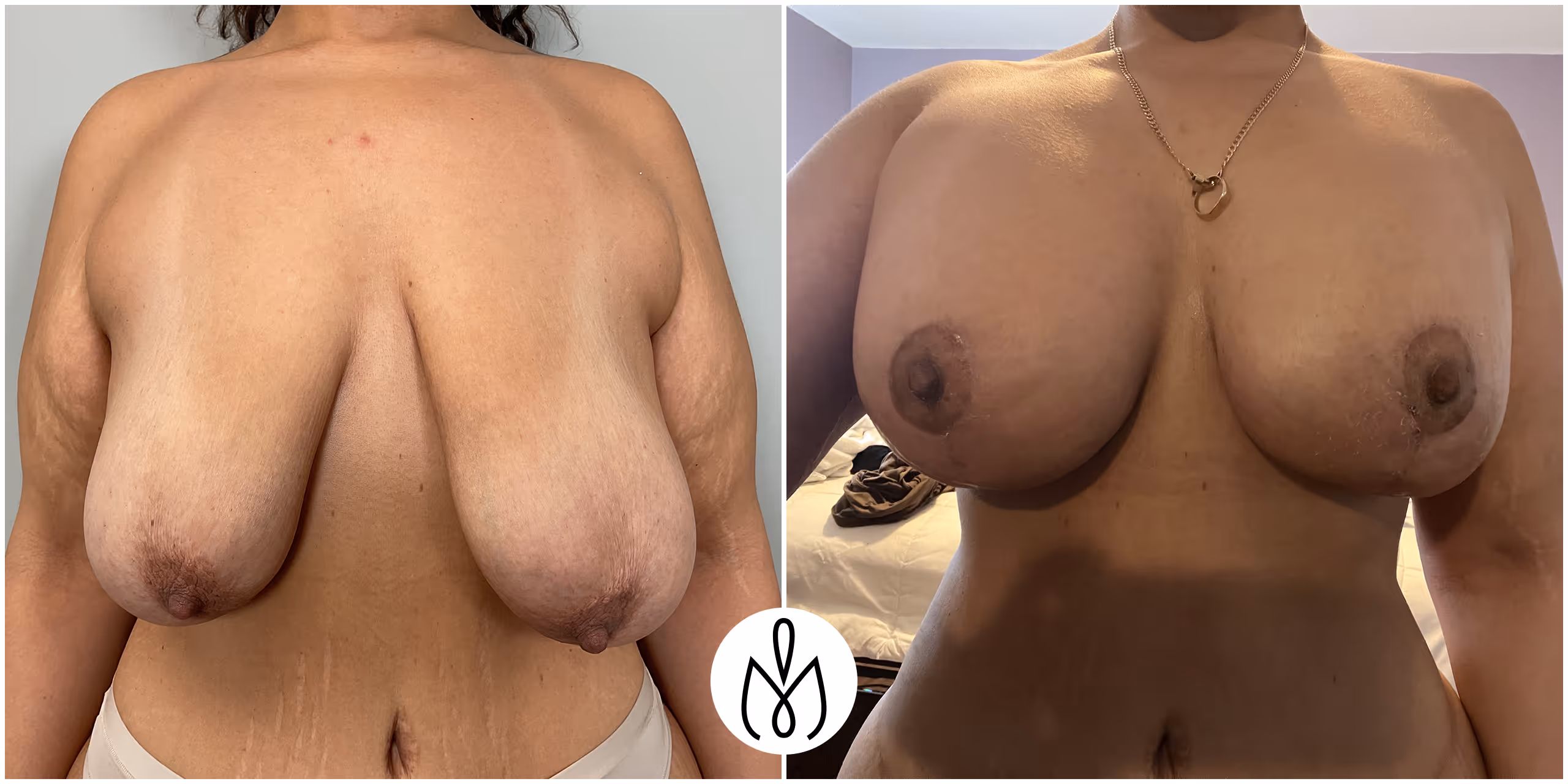 Before,After