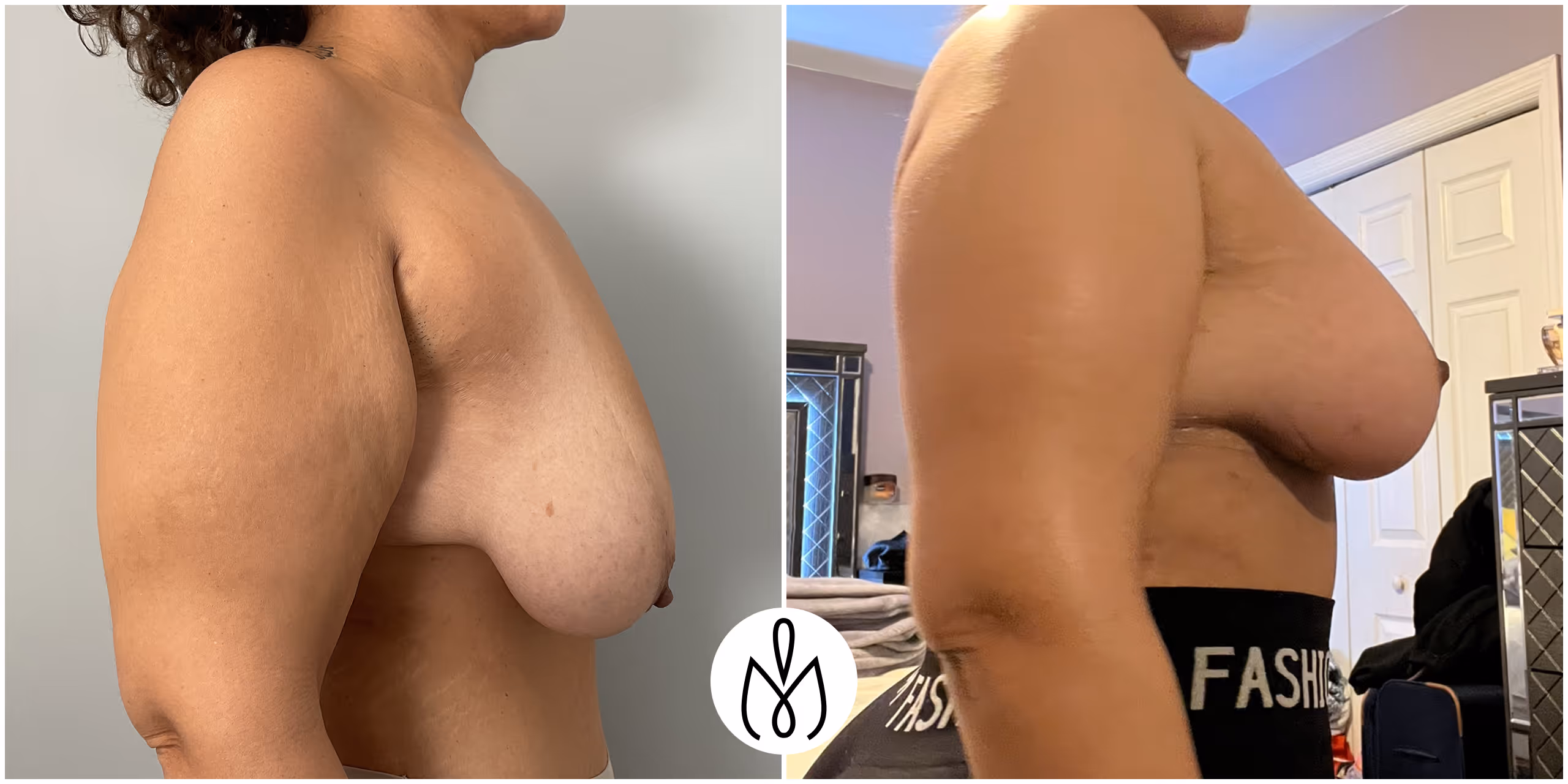 Before,After
