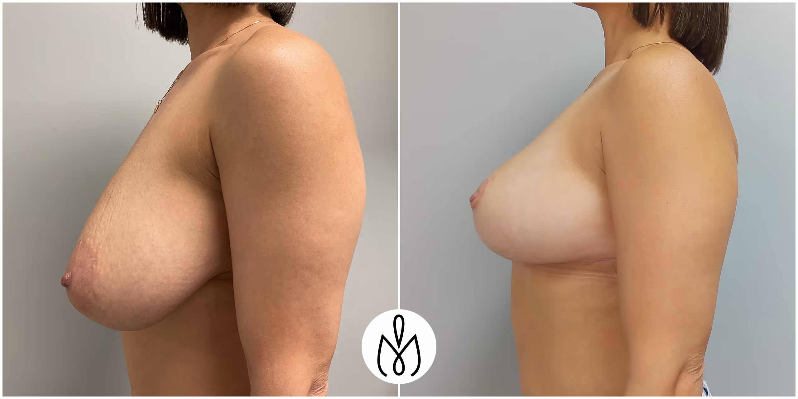 Before,After