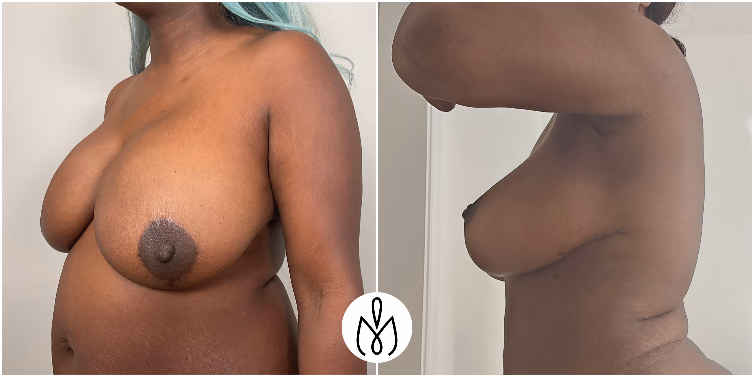 Before,After