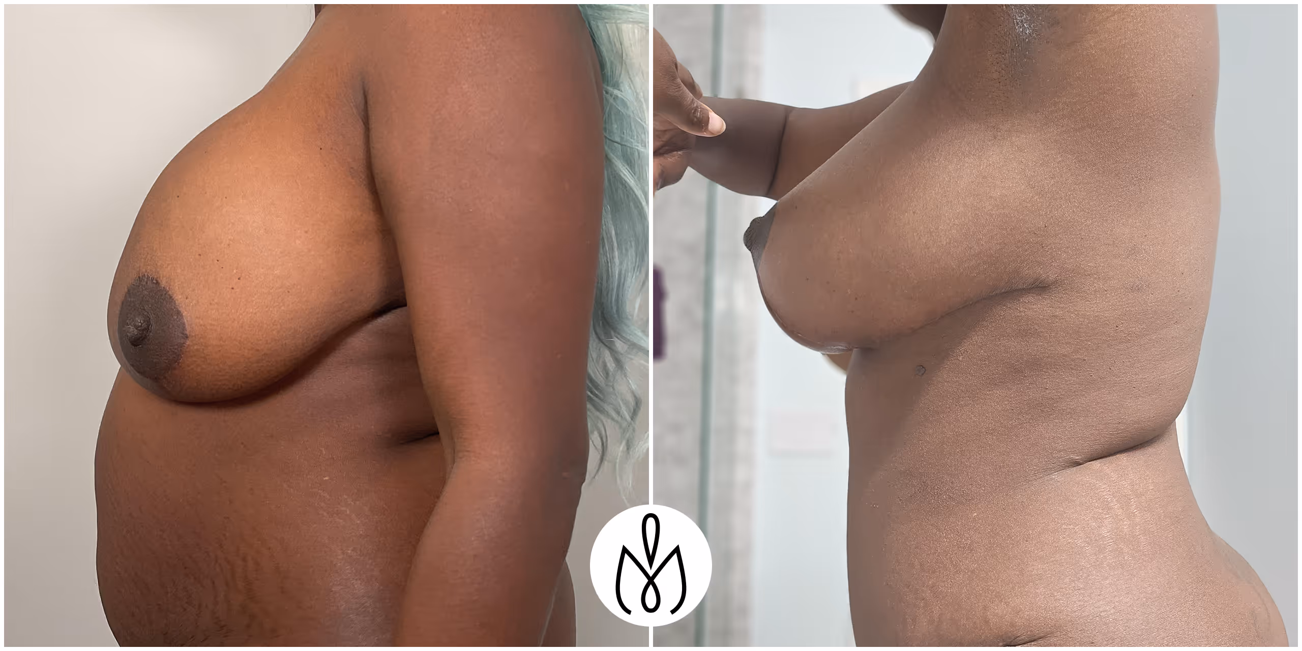 Before,After