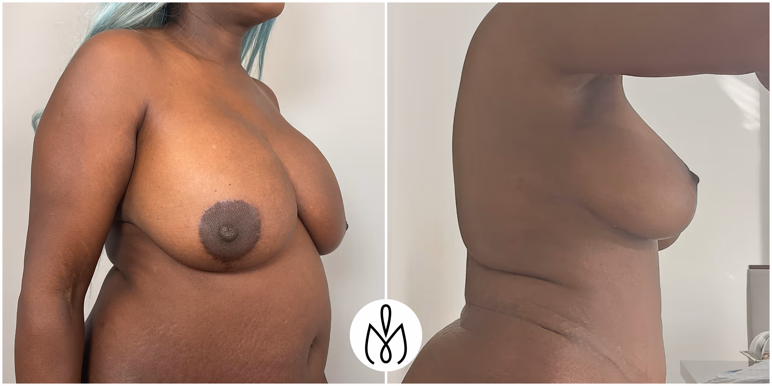 Before,After