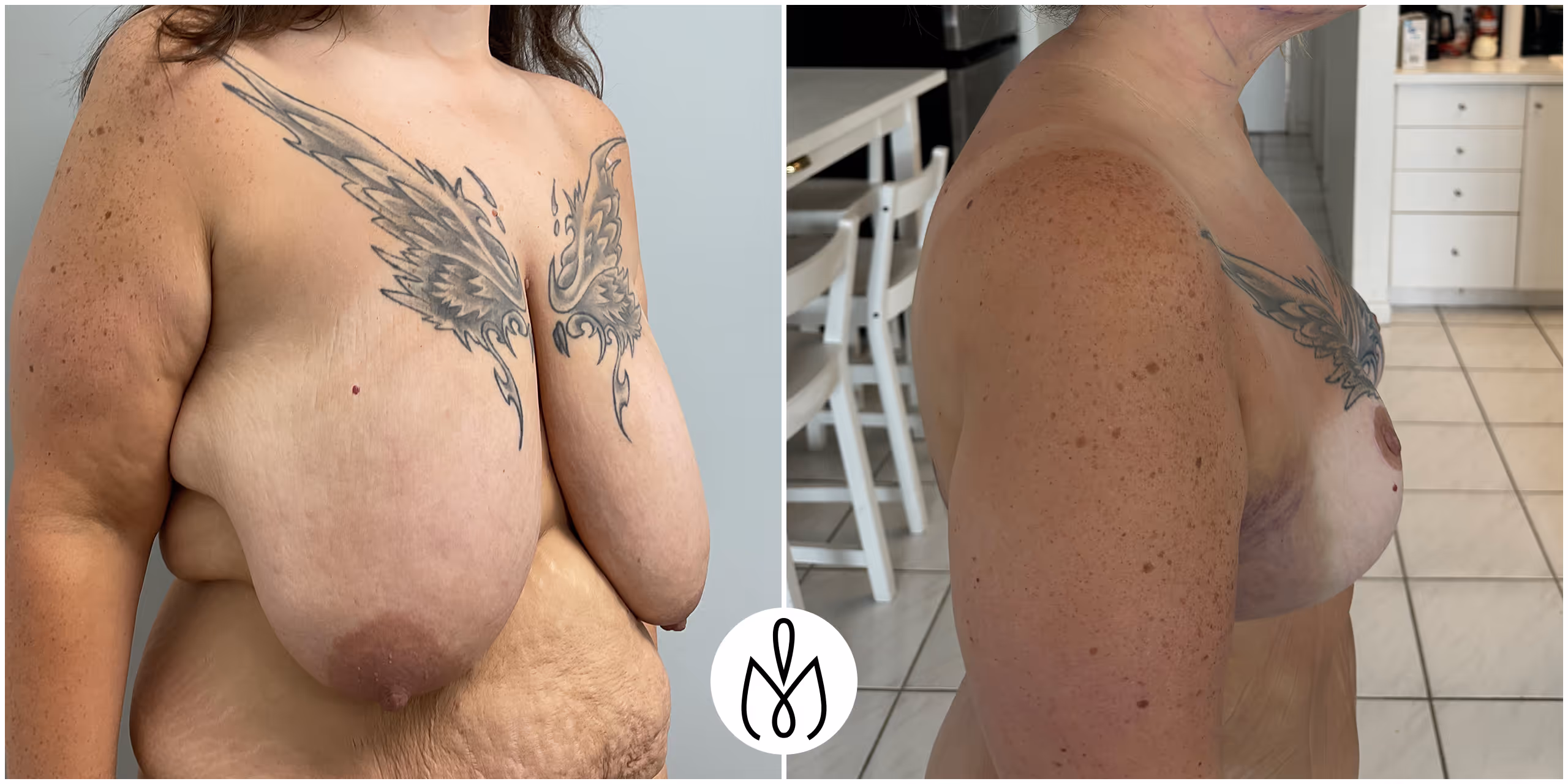 Before,After