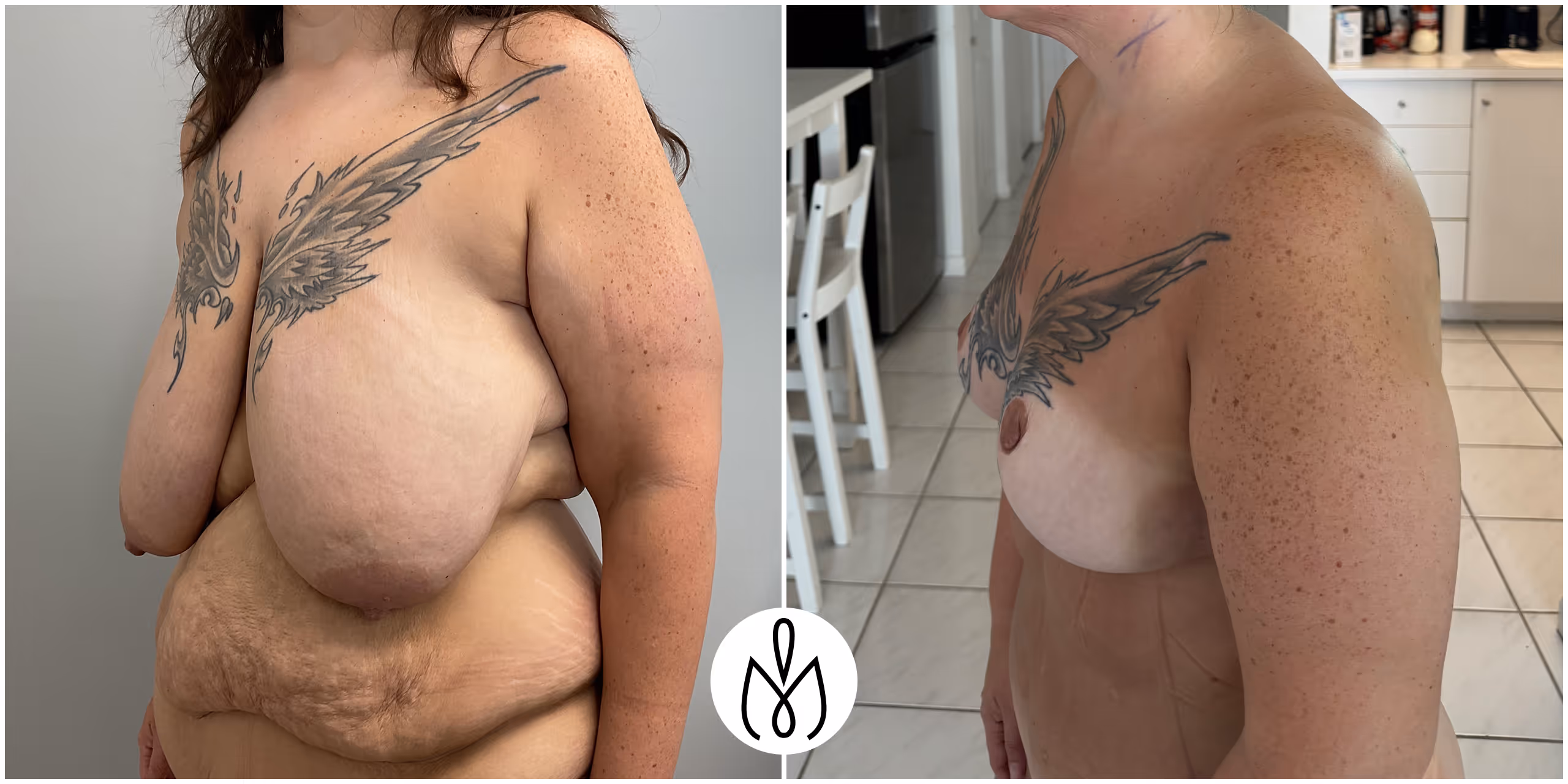 Before,After