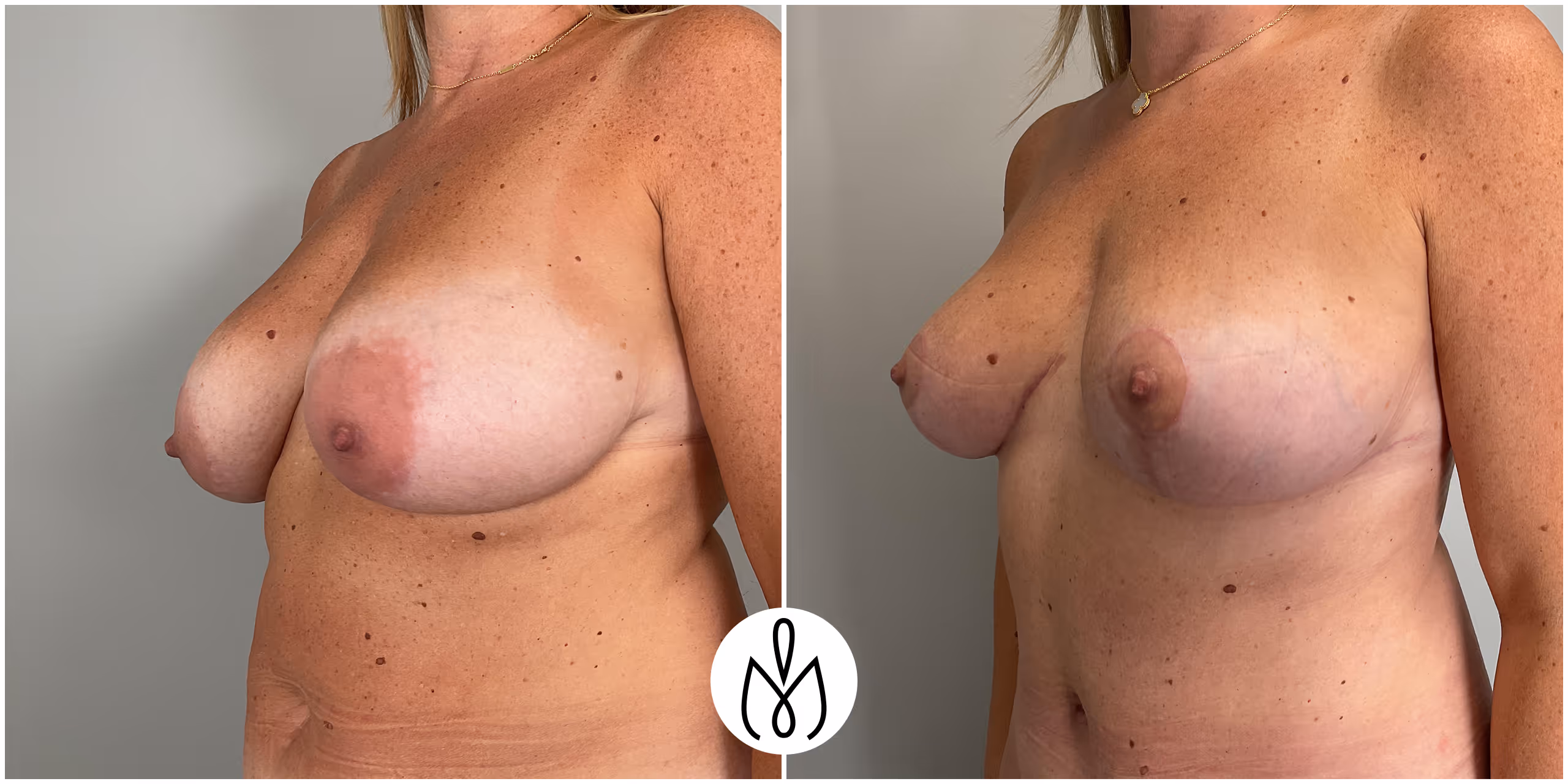 Before,After