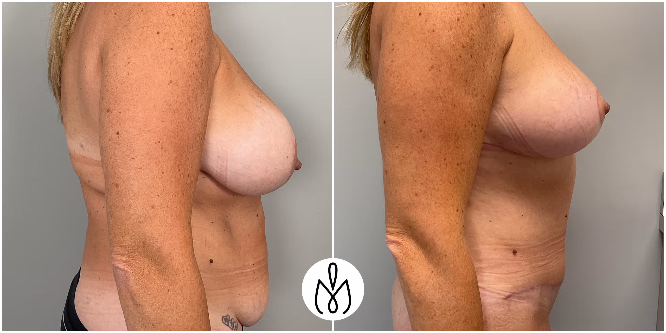 Before,After