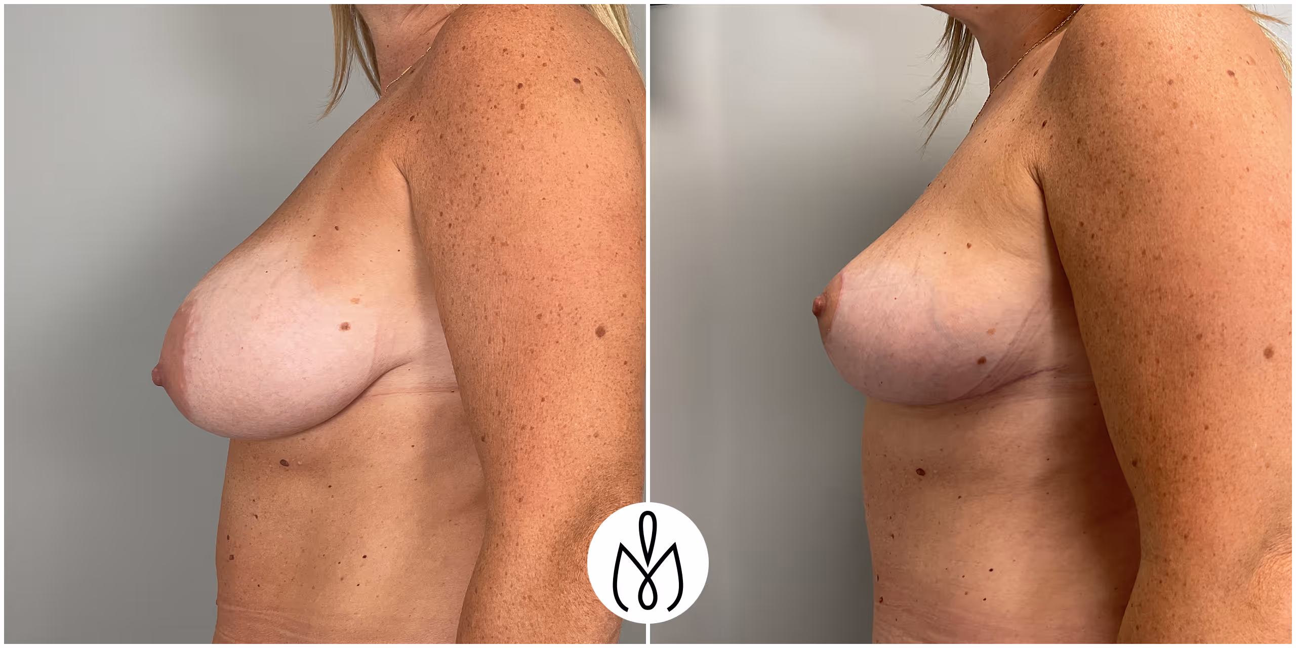 Before,After