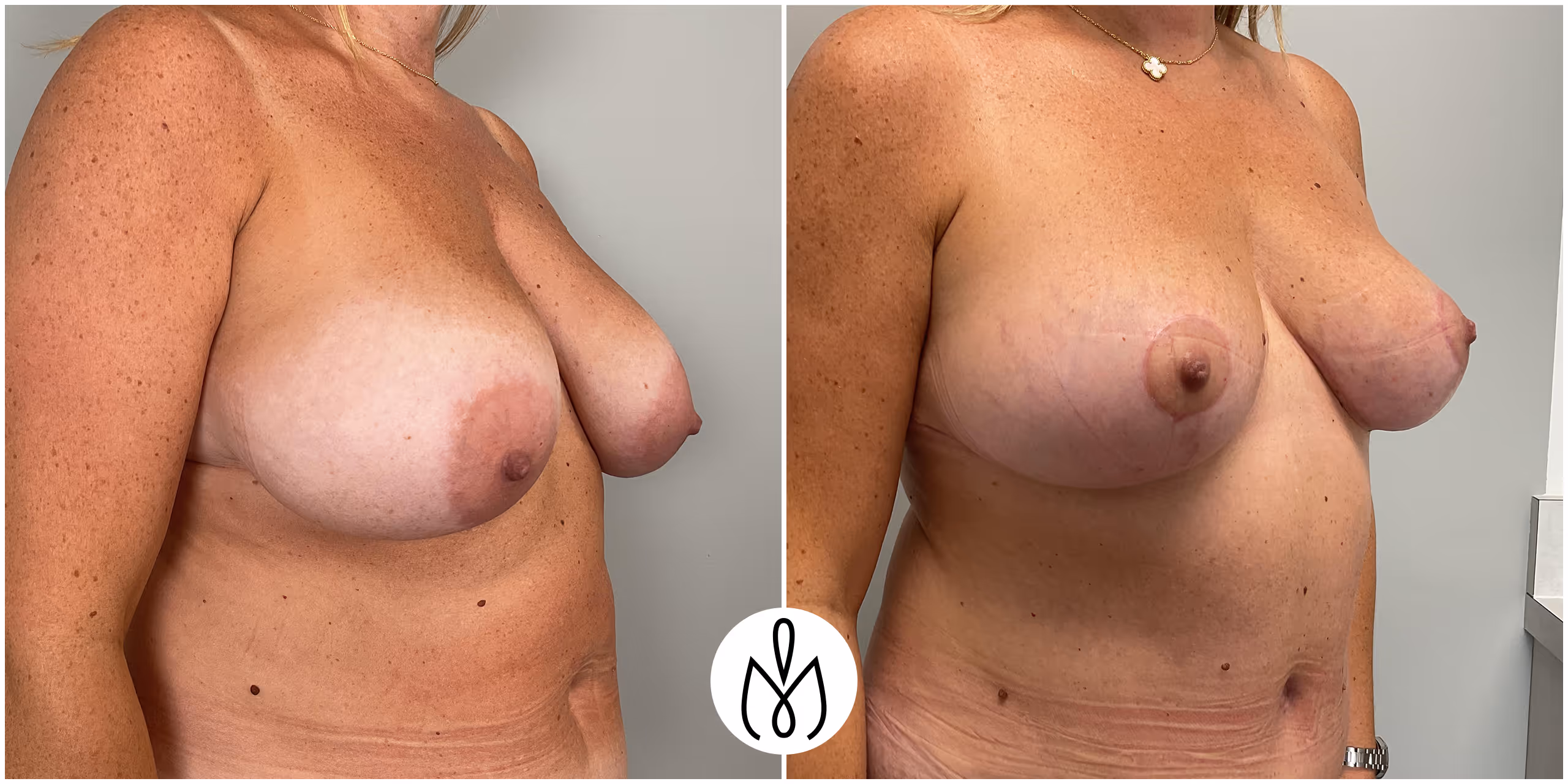 Before,After
