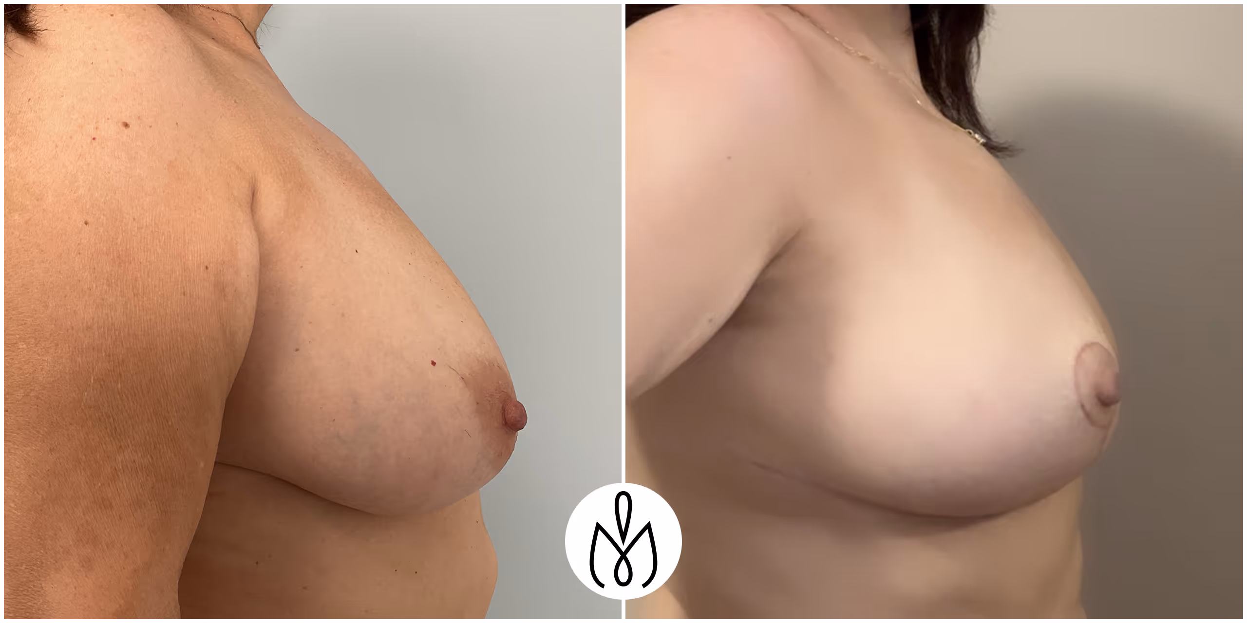 Before,After