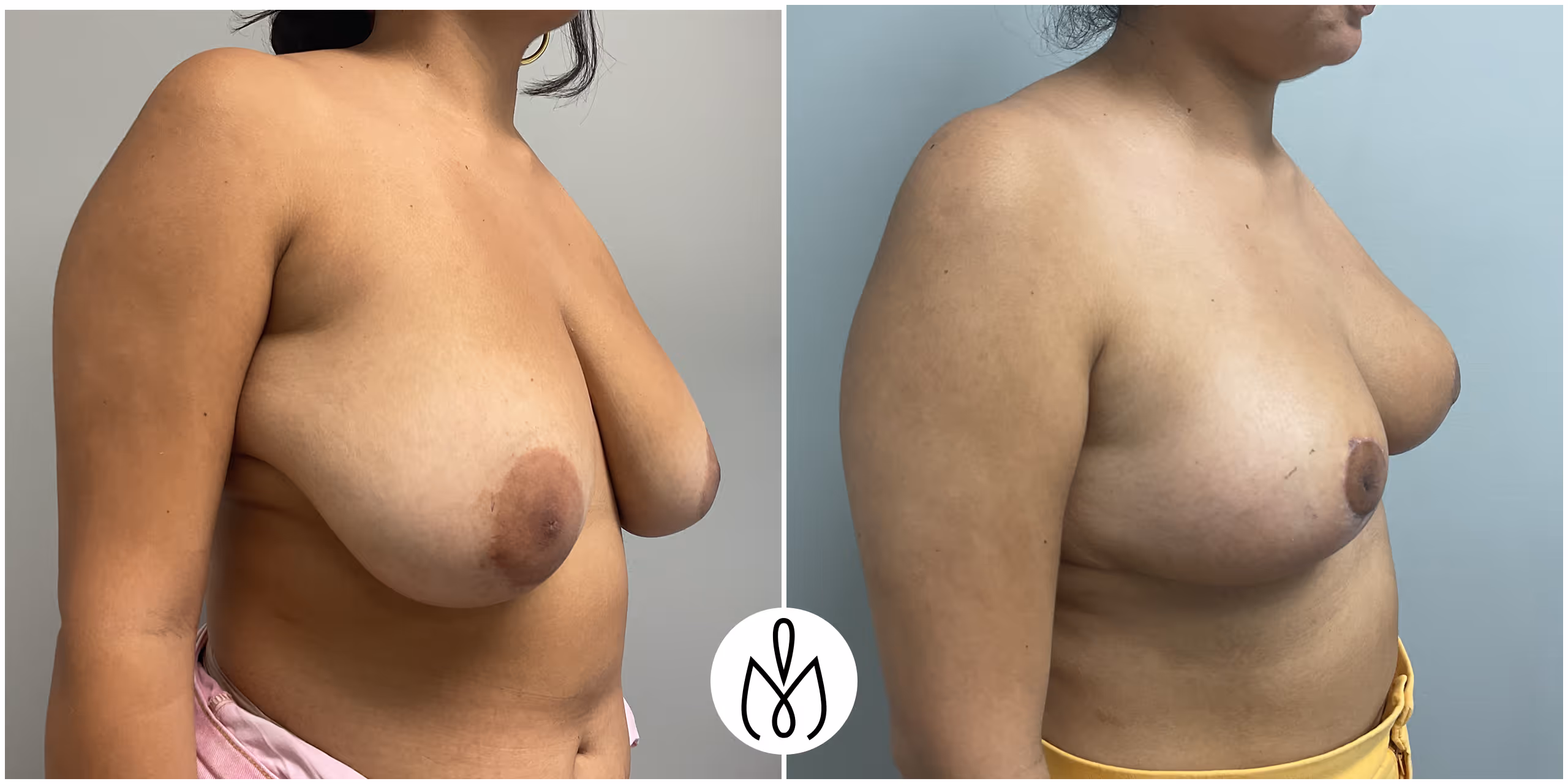 Before,After