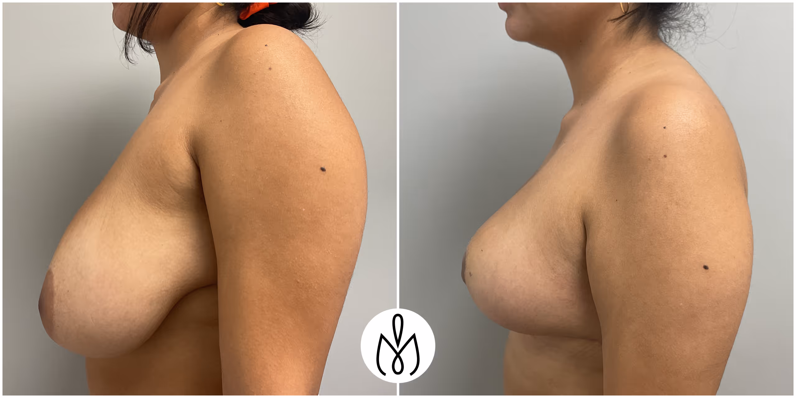 Before,After