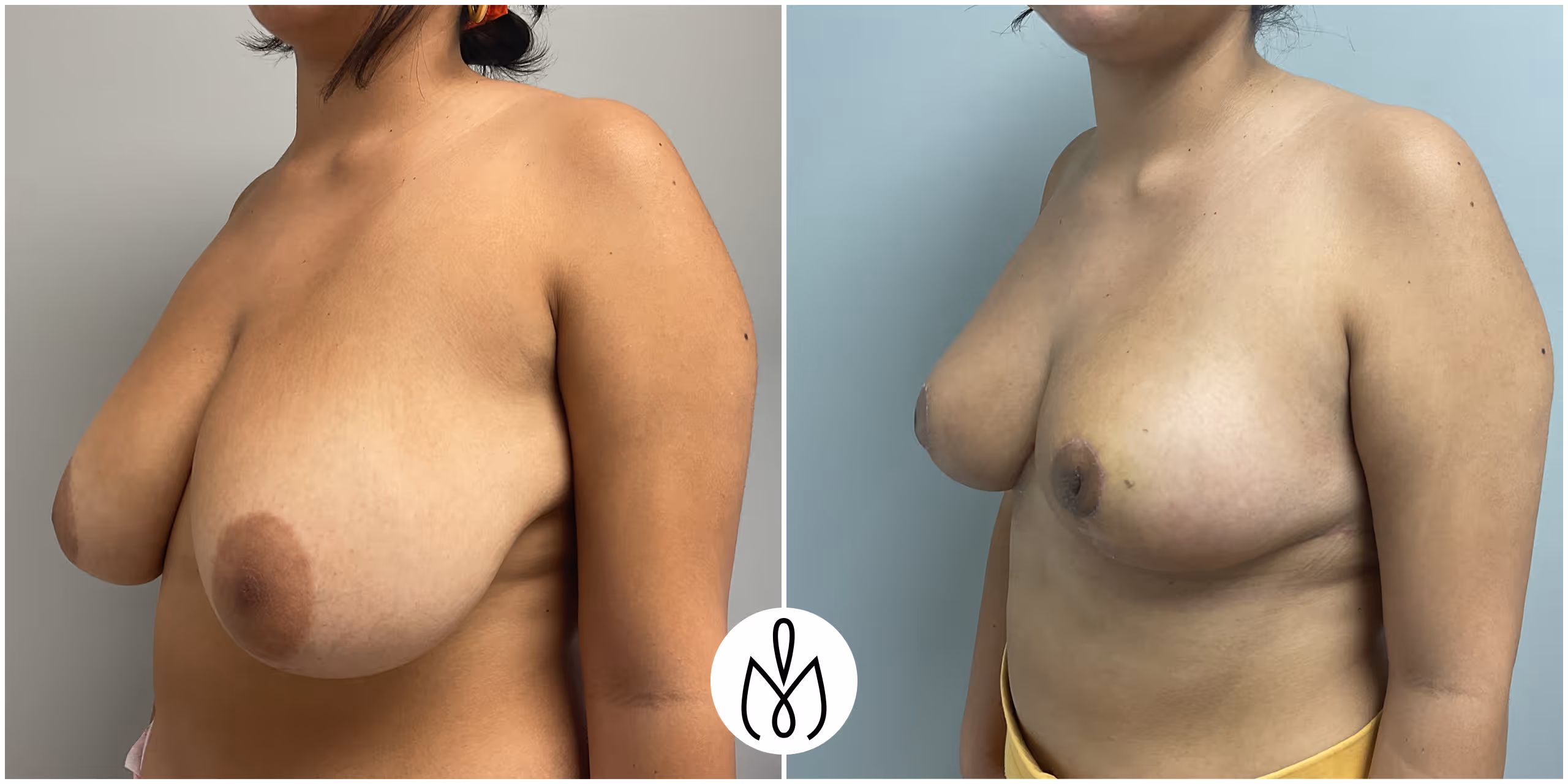 Before,After