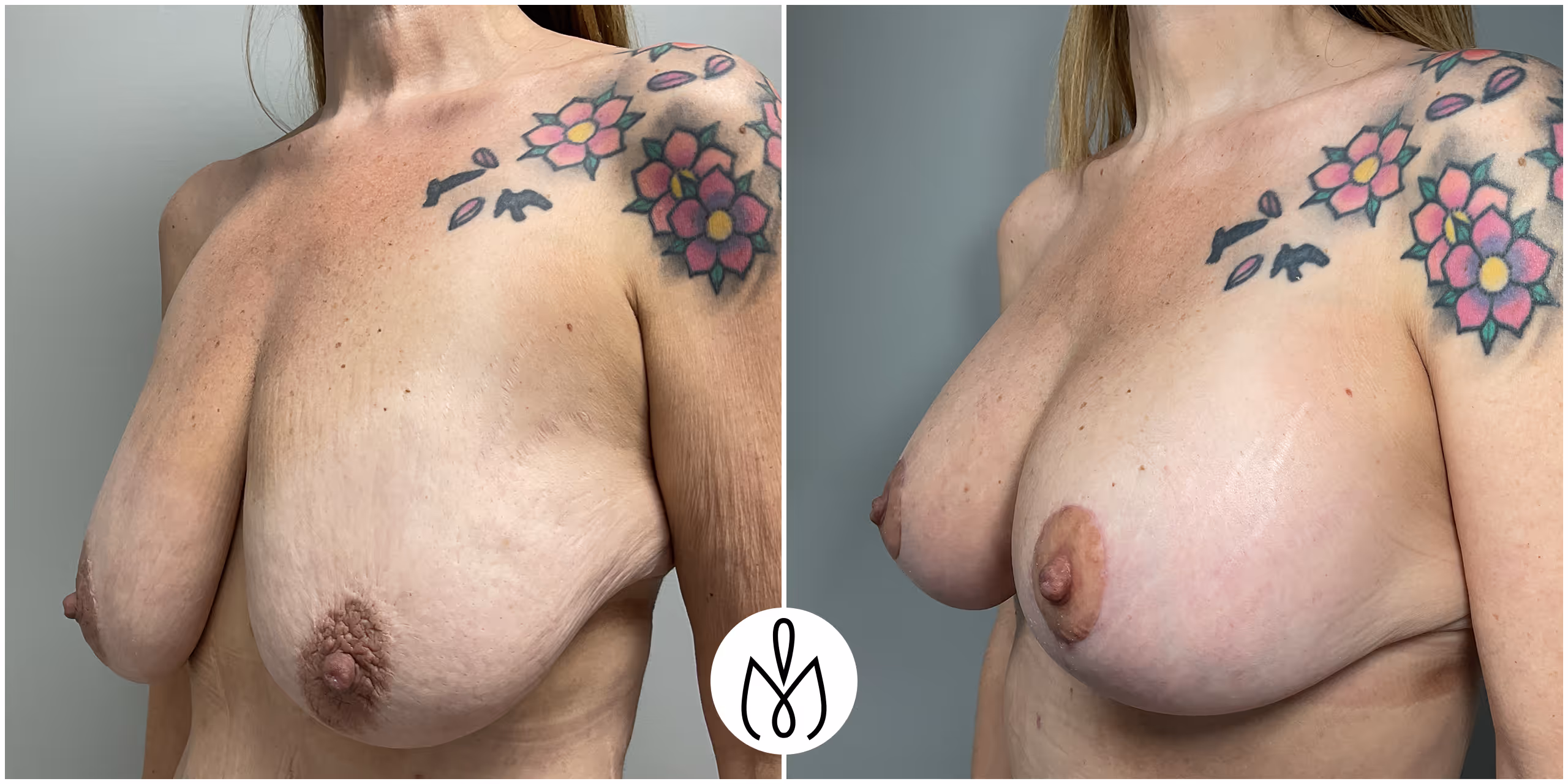 Before,After