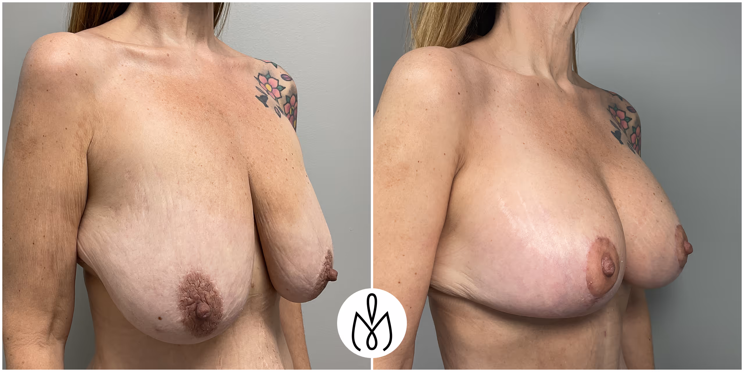 Before,After