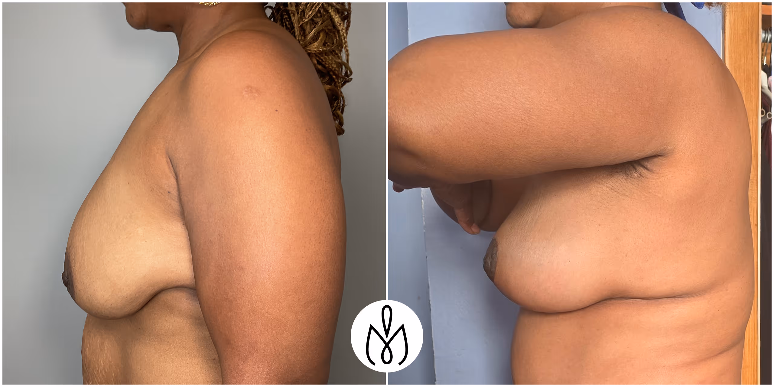 Before,After