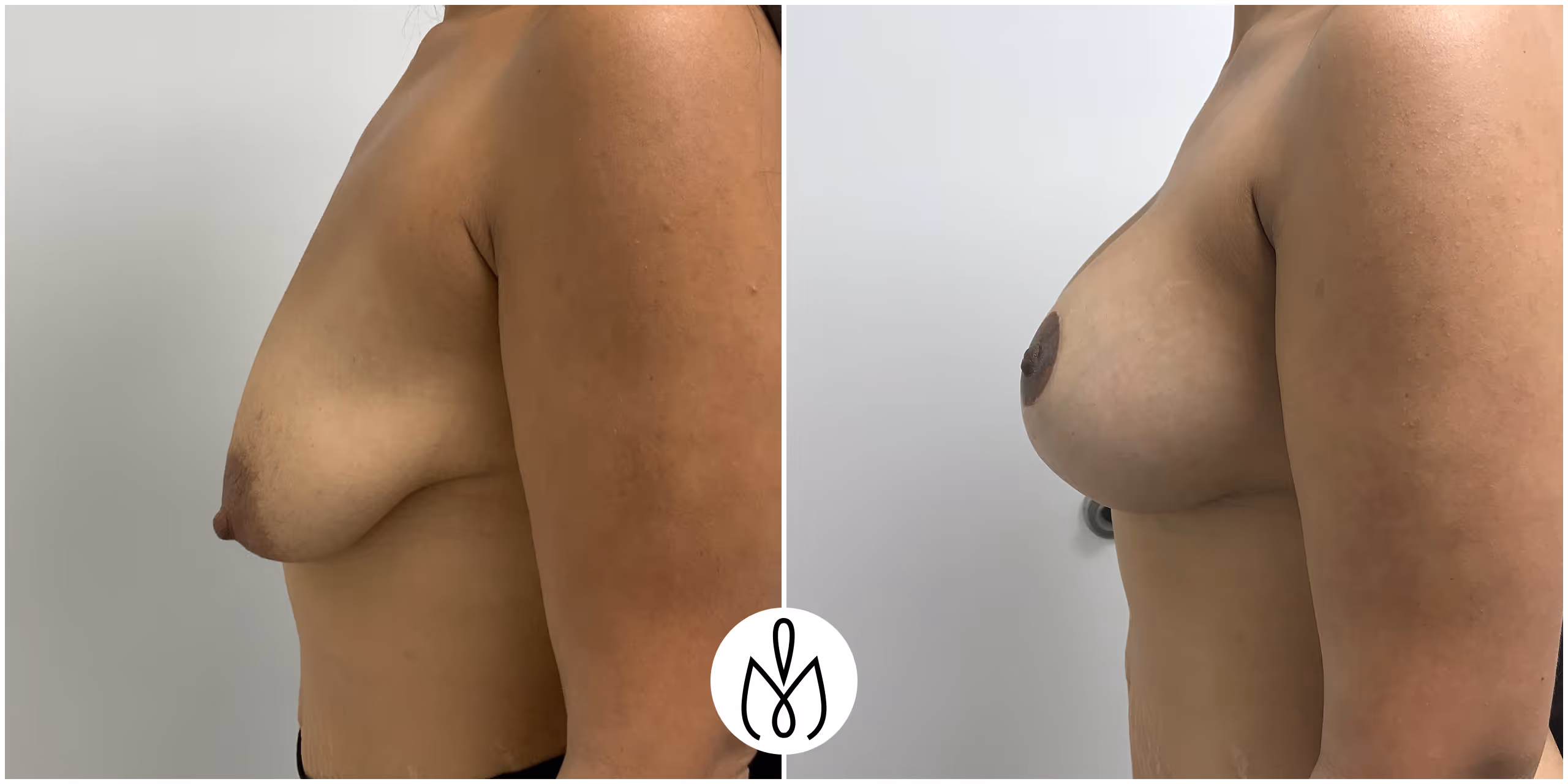 Before,After