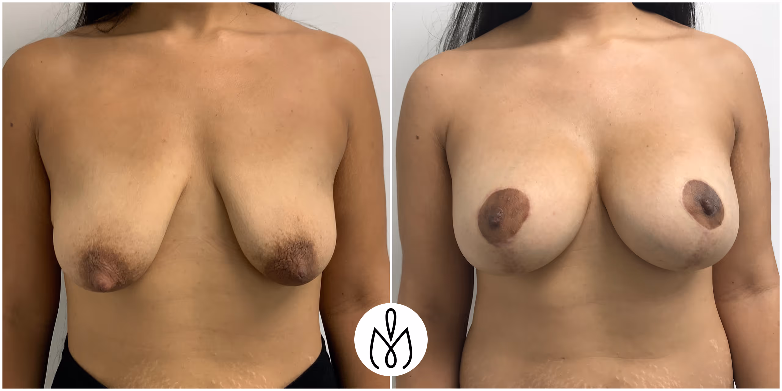 Before,After