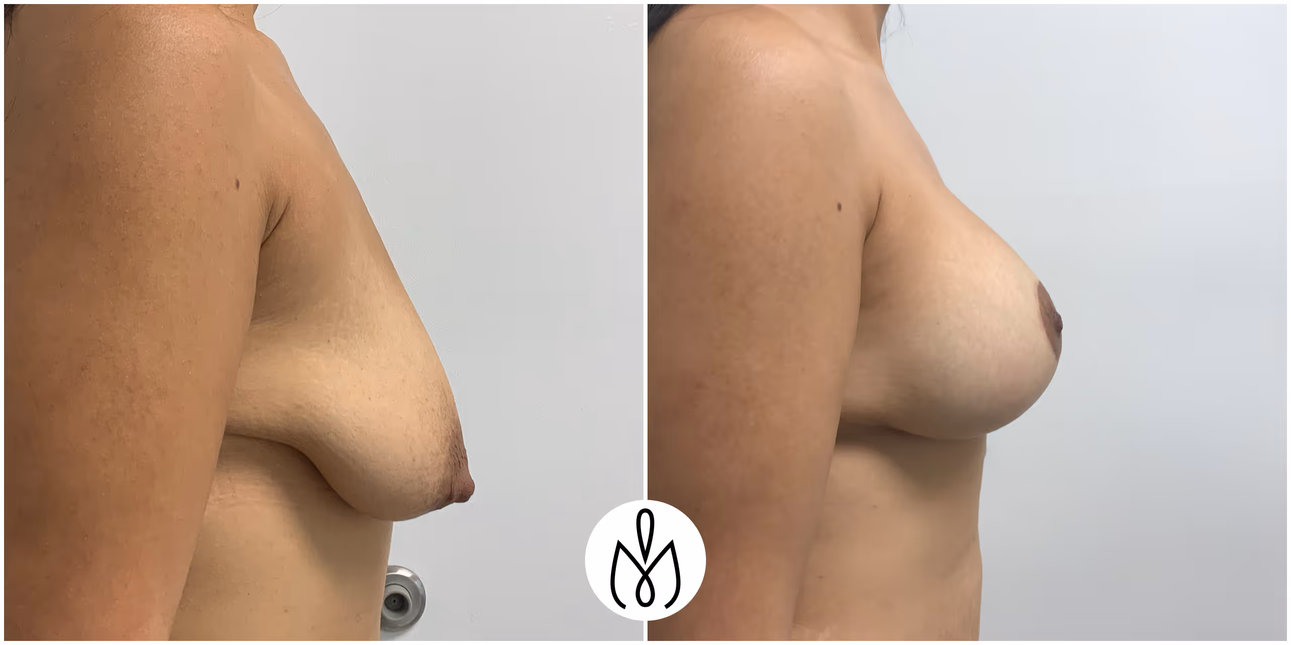 Before,After