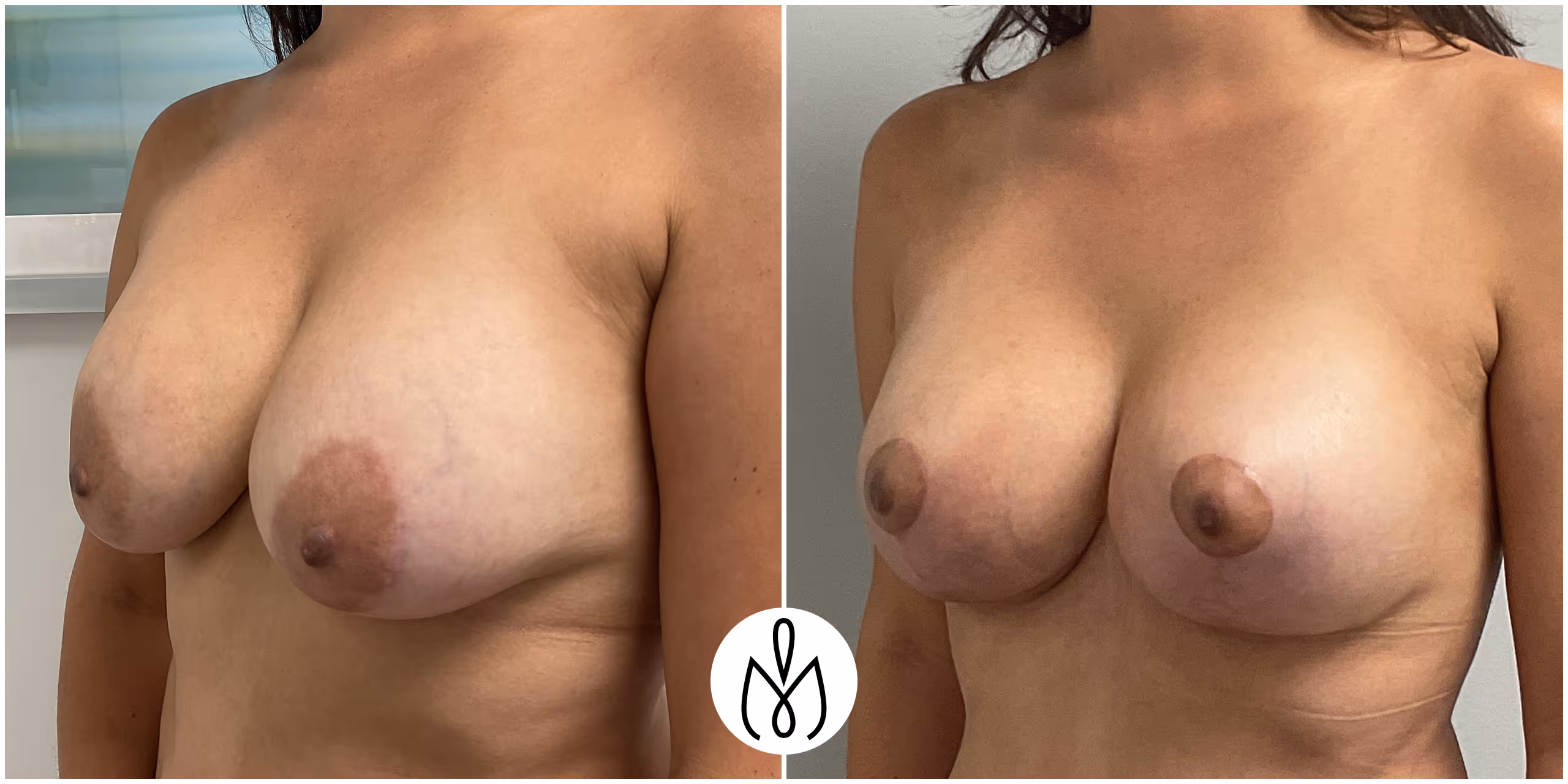 Before,After