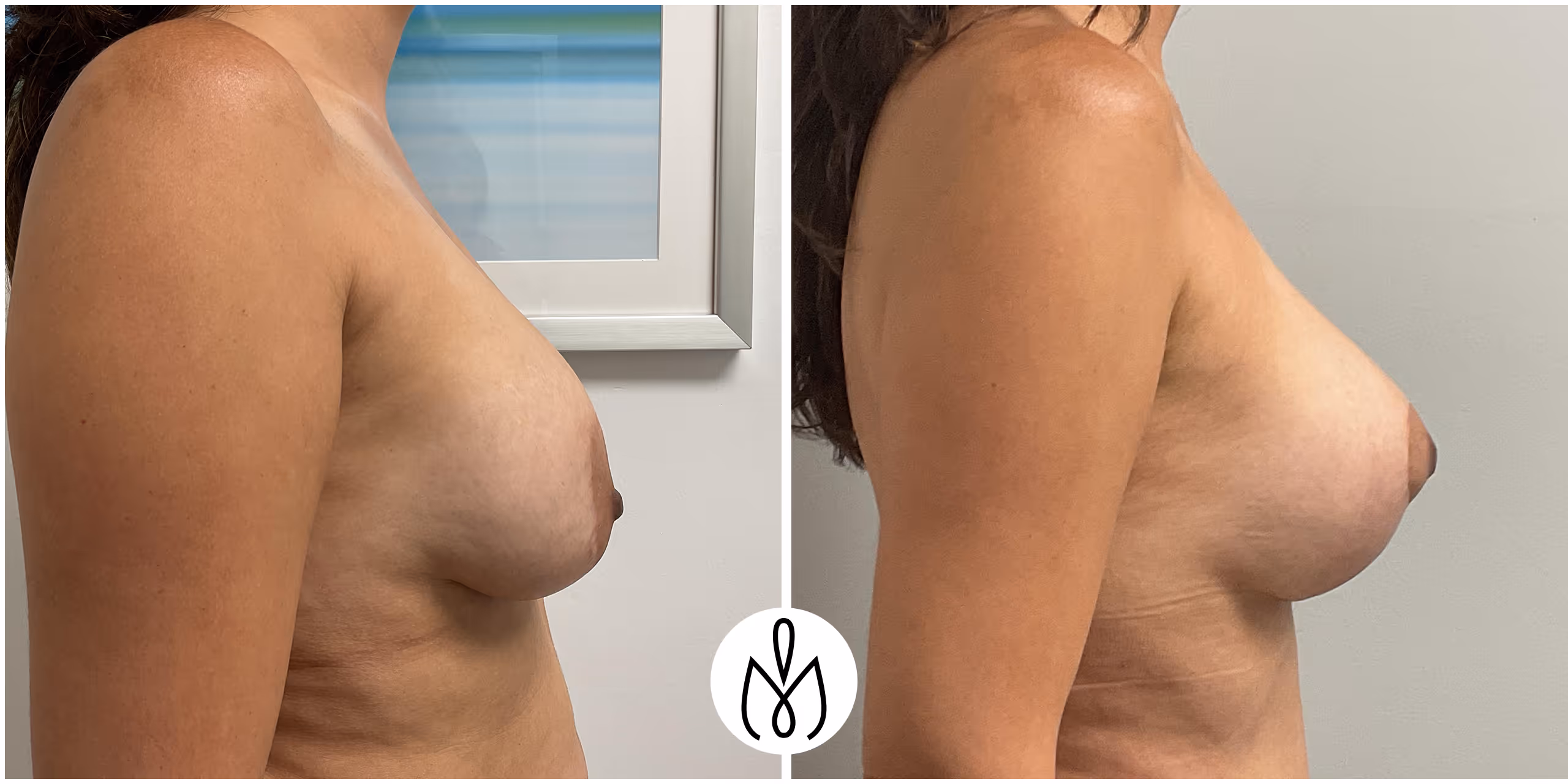 Before,After